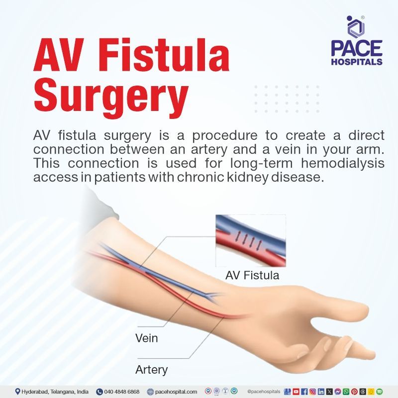 AV fistula surgery meaning AV fistula surgery | AV fistula surgery for dialysis | what is an AV fistula for dialysis | Visual explaining the meaning of AV fistula surgery procedure