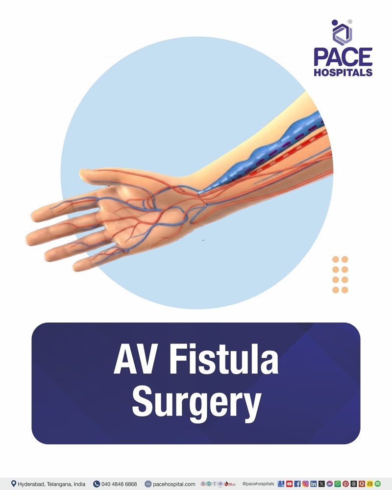 AV Fistula Surgery Cost in Hyderabad | Affordable AV Fistula Surgery in India