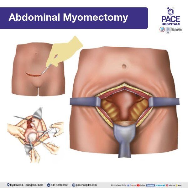 Abdominal Myomectomy for Uterine Fibroids Treatment Abdominal Myomectomy in Hyderabad | Laparotomy in Hyderabad | Laparotomy surgery