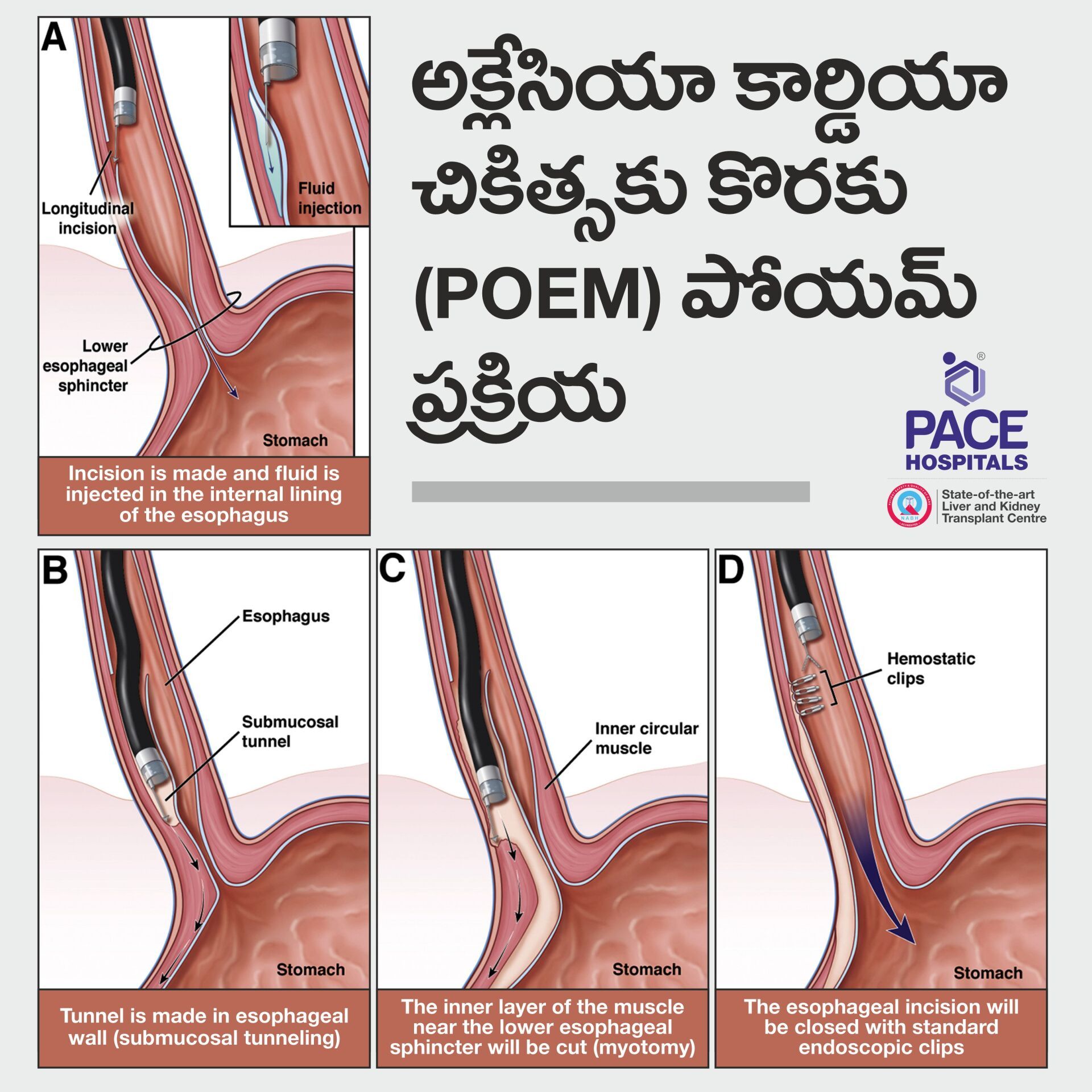 Achalasia Cardia POEM - Peroral Endoscopic Myotomy