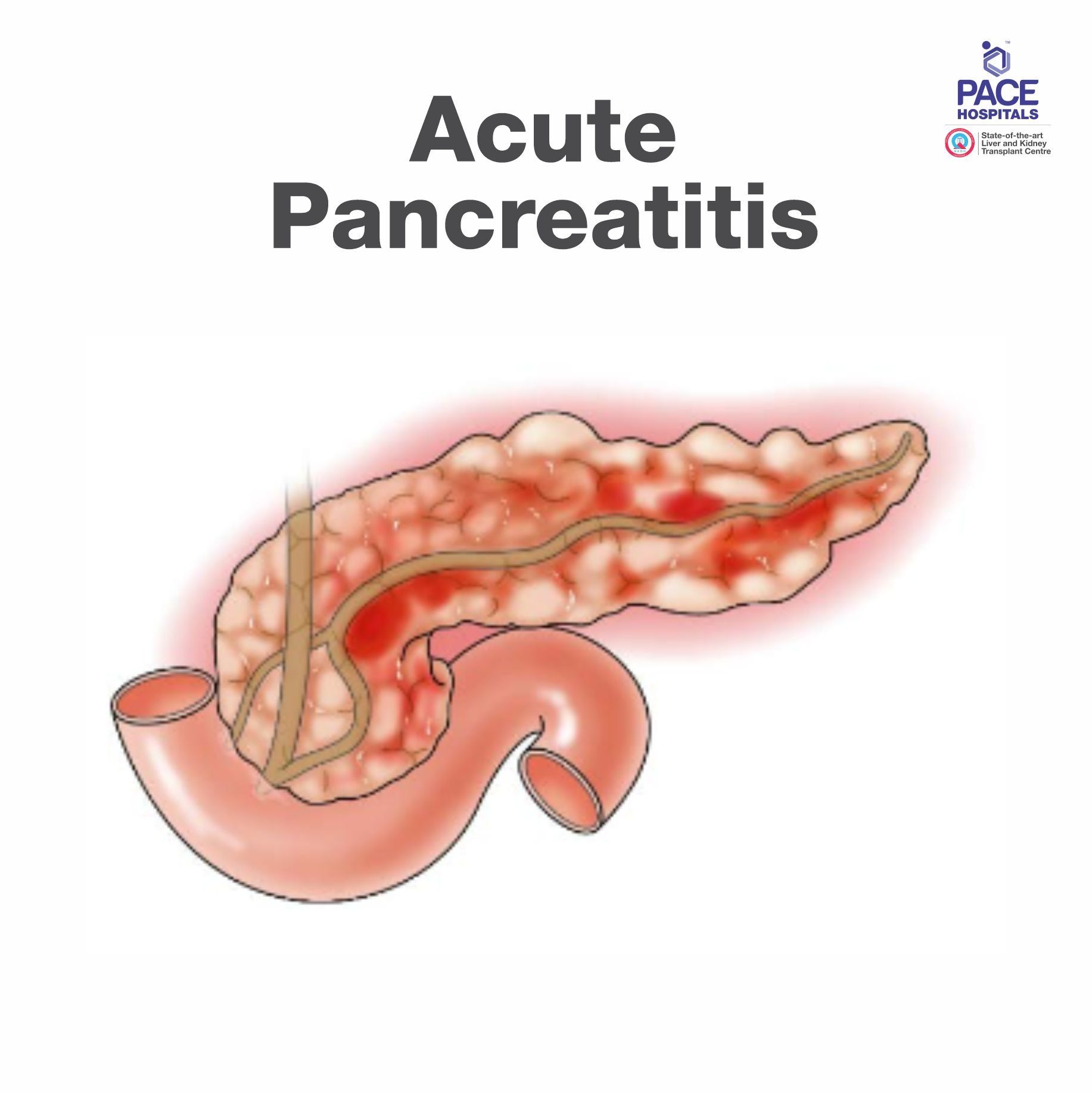Acute Pancreatitis Treatment in Hyderabad