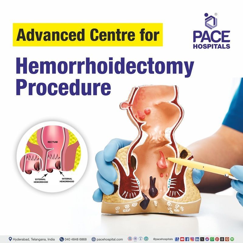 Advanced Centre for Hemorrhoidectomy Procedure in Hyderabad, India Best Hospital for Hemorrhoidectomy Surgery in Hyderabad, India | Hemorrhoidectomy Surgery hospital in Hyderabad, Telangana, India