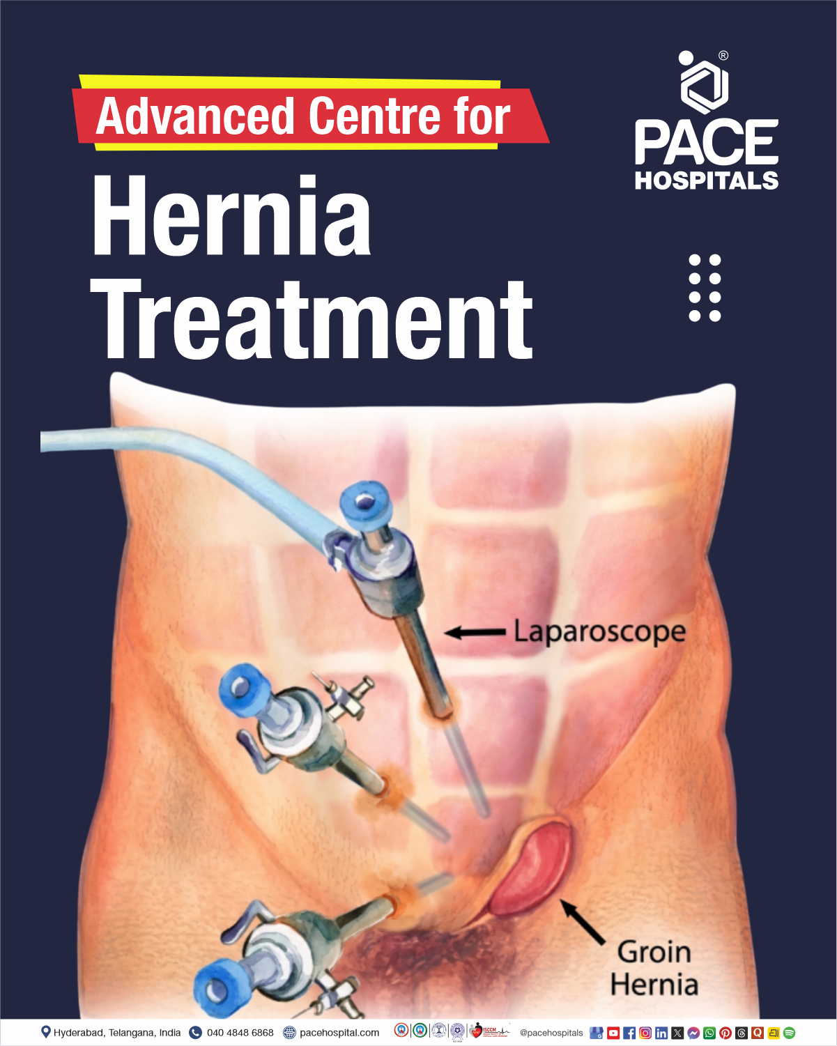 Advanced Centre for Hernia Treatment in Hyderabad, India | Minimally Invasive Hernia Treatment