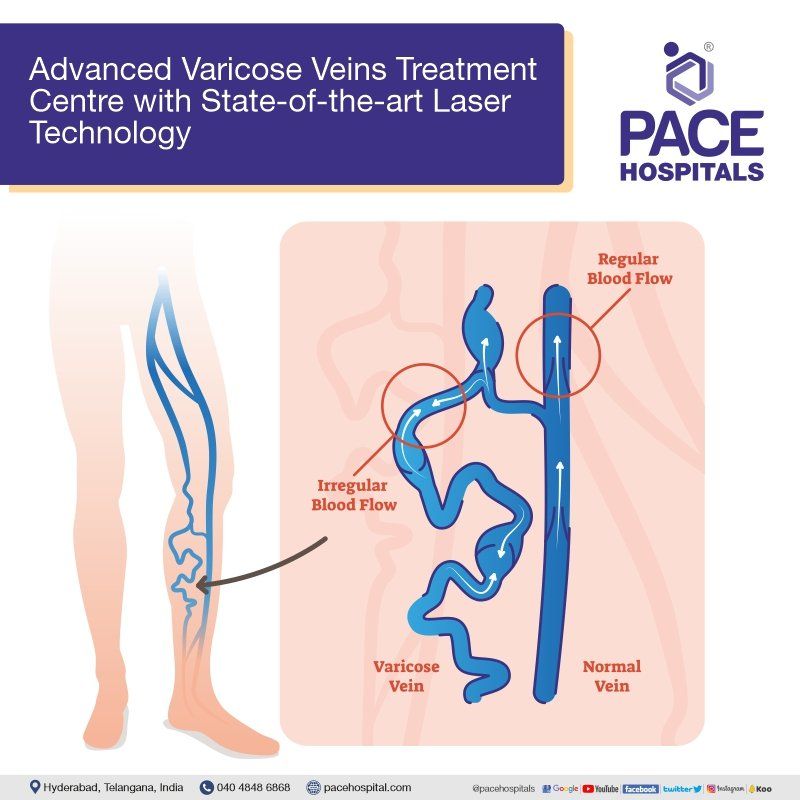 varicose veins treatment varicose veins treatment in hyderabad | varicose veins doctor | interventional radiology | interventional radiologists