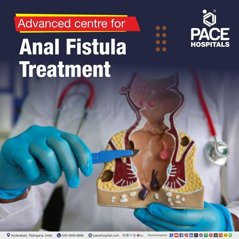 Advanced Centre for Anal Fistula Treatment in Hyderabad, India Anal fistula treatment hospital in Hyderabad | Best hospital for fistula in ano treatment in Hyderabad, India