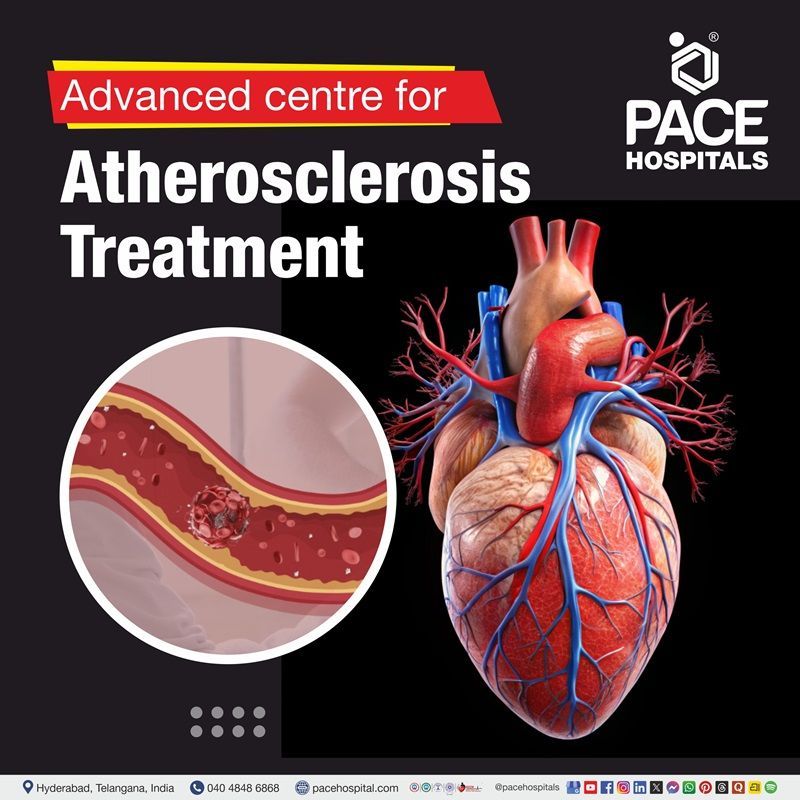 Advanced Centre for Atherosclerosis Treatment in Hyderabad, India atherosclerosis treatment hospital in Hyderabad | top hospital for atherosclerosis treatment in Hyderabad, India