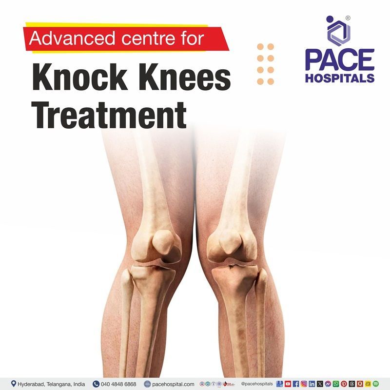 Advanced Centre for Knock Knees Treatment Treatment in Hyderabad, India knock knees treatment hospital in Hyderabad | best hospital for genu valgum treatment in Hyderabad, India