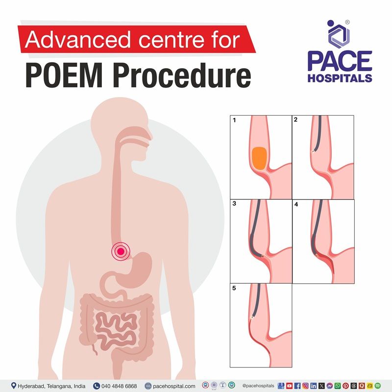 Best Hospital for POEM procedure in Hyderabad | POEM Surgery in Hyderabad, India
