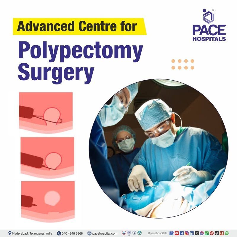 Advanced Centre for Polypectomy surgery in Hyderabad, India Best hospital for Polypectomy surgery in Hyderabad | Polypectomy surgery cost in Hyderabad | Polyps Removal Surgery hospital in Hyderabad, India