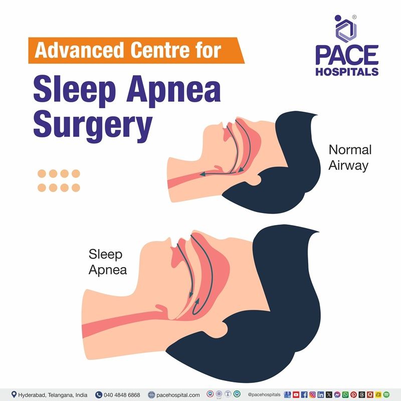 Advanced centre for sleep apnea surgery in Hyderabad Sleep apnea surgery in Hyderabad | obstructive sleep apnea surgery cost in India
