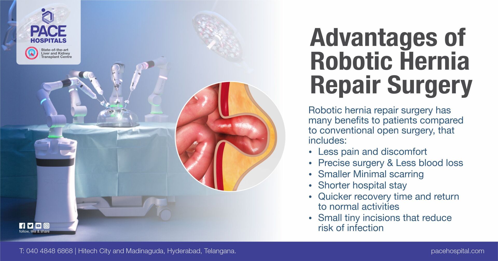 Advantages and Benefits of Robotic Hernia Repair Surgery in Hyderabad hernia surgery cost in Hyderabad | hernia laparoscopic surgery cost in Hyderabad | hernia surgery in Hyderabad | best hospital in Hyderabad for hernia surgery | hernia surgery near me | hernia operation cost in Hyderabad | best hernia treatment in Hyderabad India
