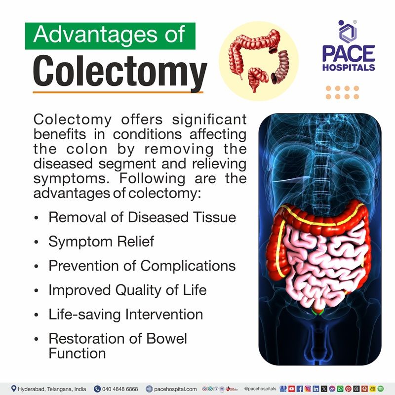Advantages of Colectomy Surgery How colectomy improves quality of life and prevents complications | Benefits of colectomy surgery