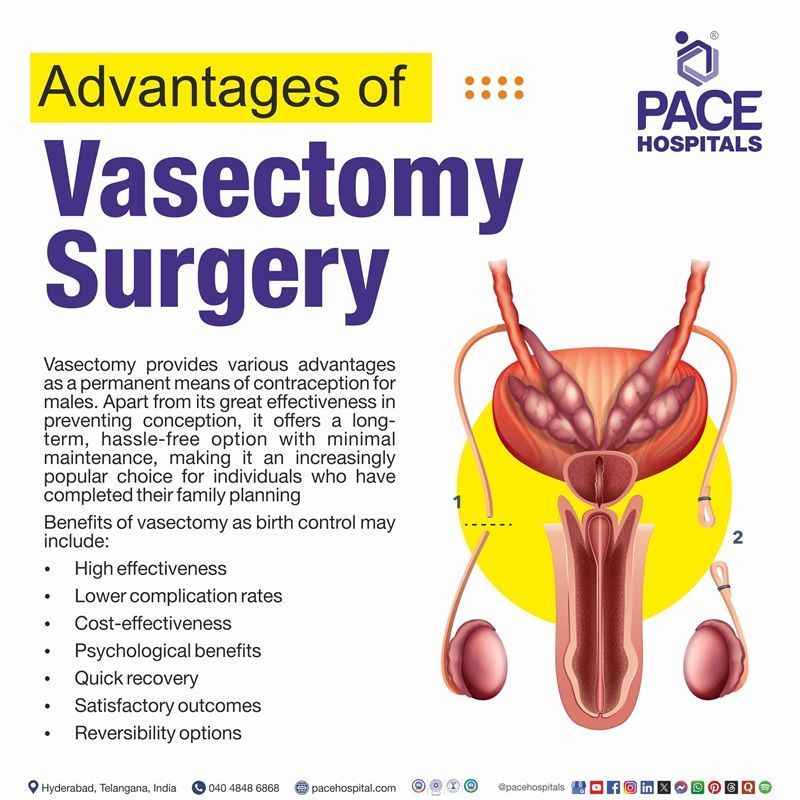 Advantages of Vasectomy Surgery | Vasectomy Surgery Advantages