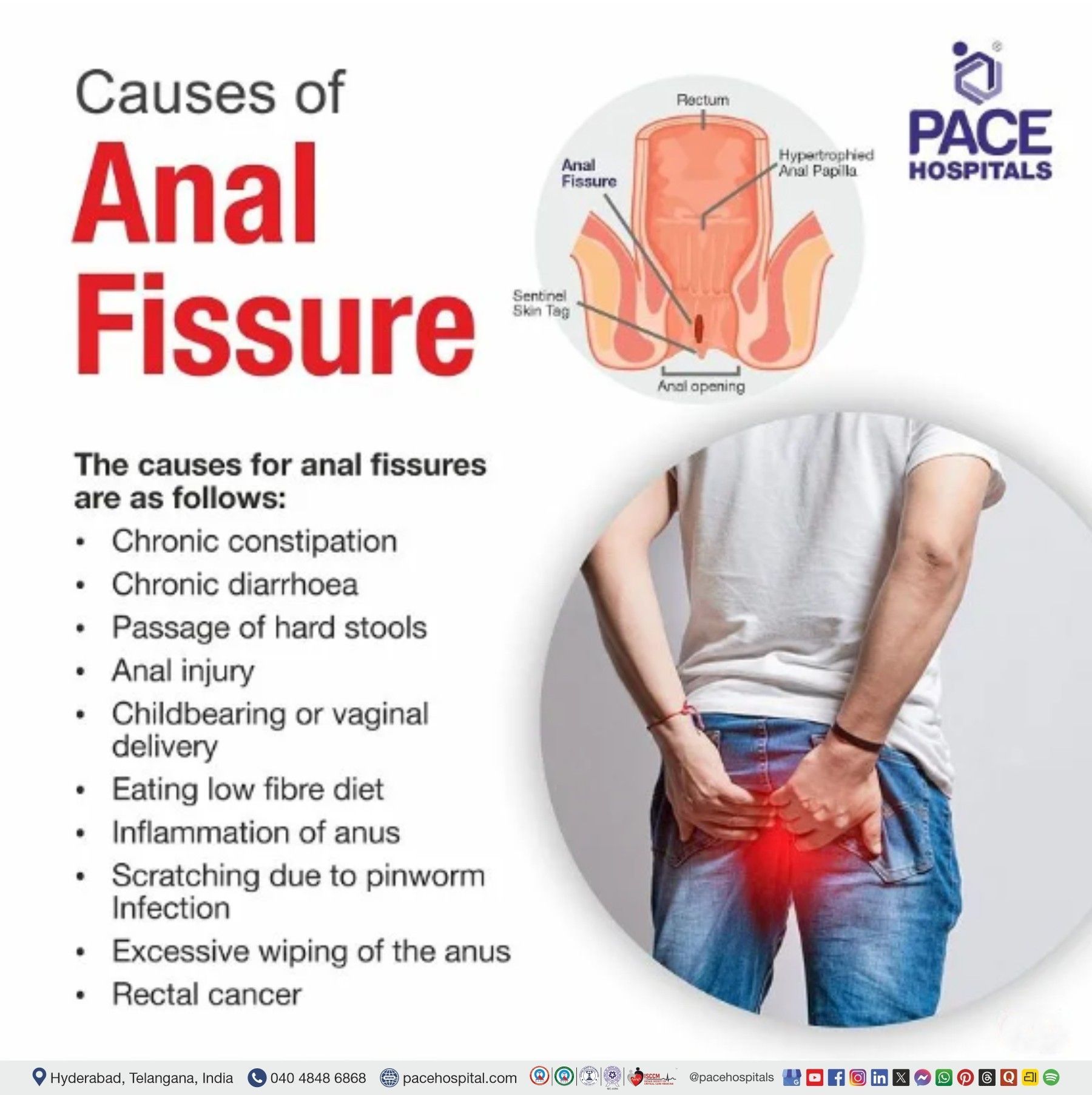 Anal Fissure Causes | Causes for Anal Fissure