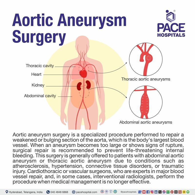 Aortic Aneurysm Surgery Meaning Aortic Aneurysm Meaning? | Visual depicting the meaning of aortic aneurysm surgery