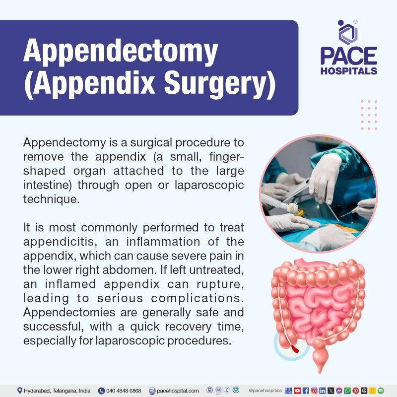 What is appendectomy procedure appendectomy definition | best appendix removal surgery hospitals in Hyderabad | appendectomy surgery cost in Hyderabad | keyhole surgery appendix Hyderabad | appendix laparoscopic surgery cost in Hyderabad India