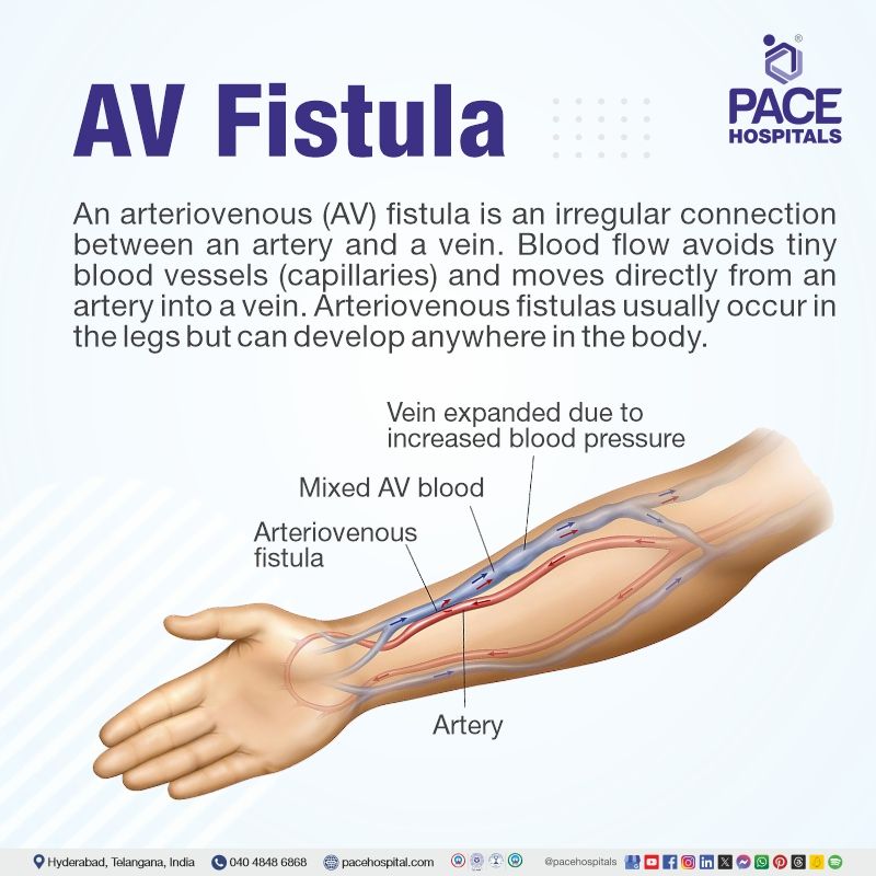 AV Fistula Meaning AV fistula | What is an AV fistula | AV fistula meaning | AV fistula definition | AV fistula procedure | Visual explaining the meaning of AV Fistula