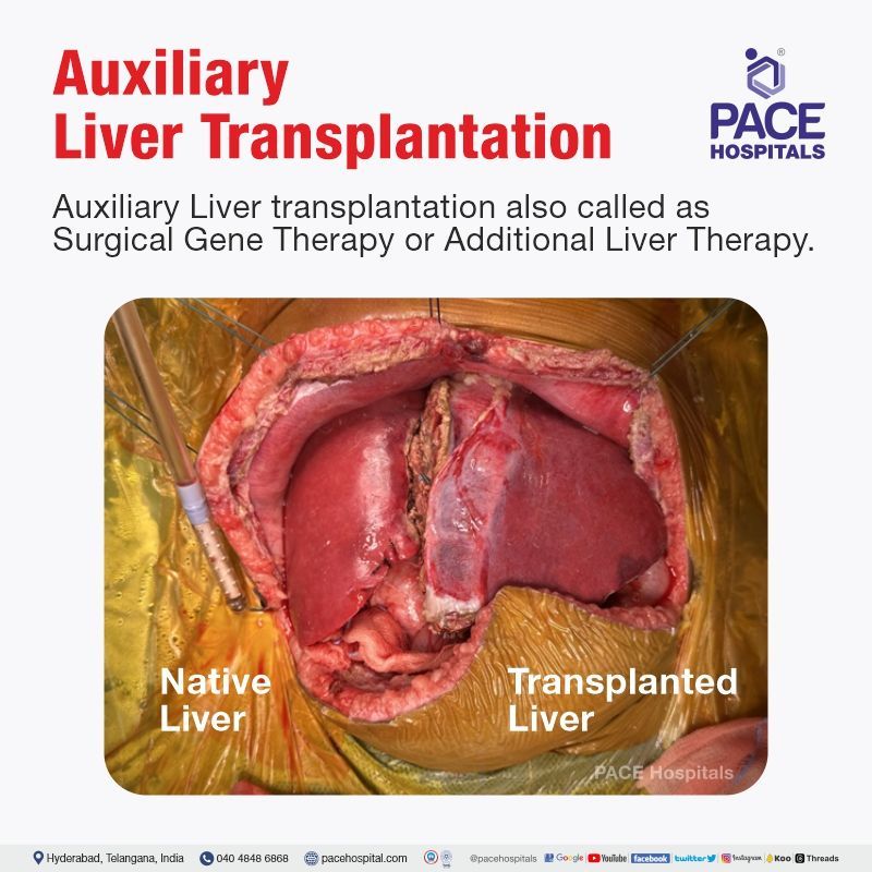 Auxiliary Liver Transplantation for Rare Genetic Liver Disease - Propionic Acidemia Auxiliary liver transplantation for Propionic Acidemia | the best hospital for liver transplant in India | Top Liver transplant surgeons | Surgical Gene Therapy | Additional Liver Therapy