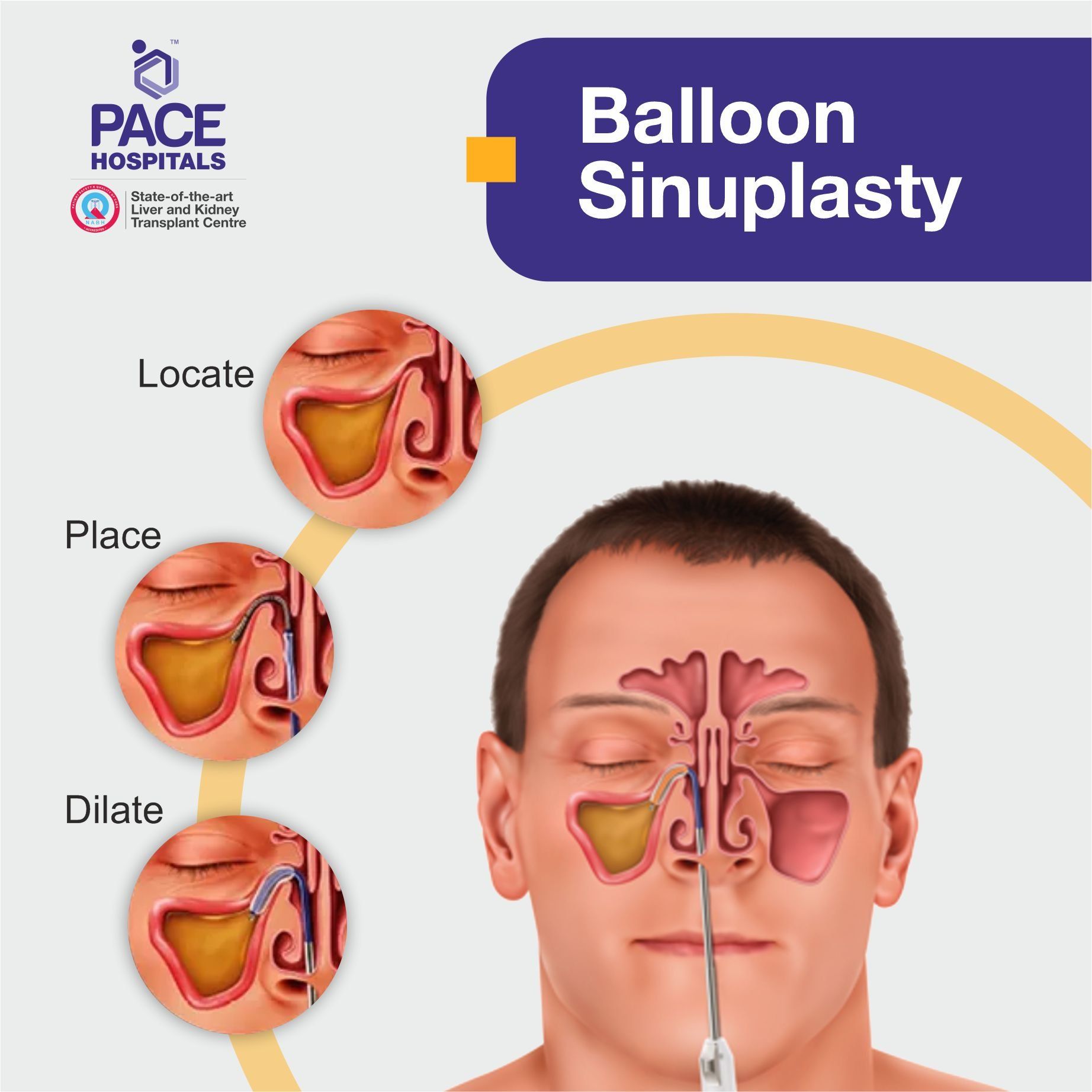 Balloon Sinuplasty Sinus Surgery in Hyderabad, Telangana, India Balloon Sinuplasty Sinus Surgery in Hyderabad, Telangana, India