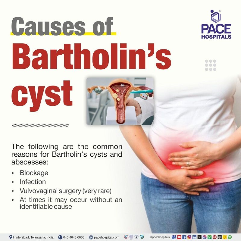 Causes of Bartholin’s cyst what causes Bartholin's cyst and abscess | causes of Bartholin's cyst and abscess | Bartholin's cyst causes
| Visual explaining the causes of Bartholin's cyst