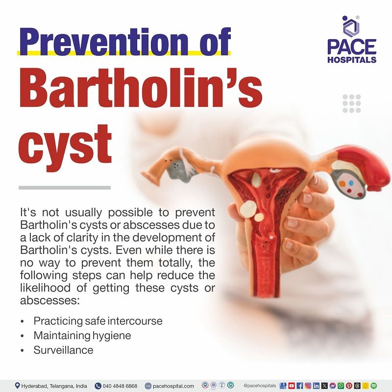 Bartholin's cyst Preventive measures Bartholin cyst prevention | Bartholin gland cyst prevention | preventive tips for Bartholin cyst | Visual depicting the | preventive measure for Bartholin cyst