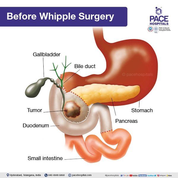 Before the Whipple procedure | whipple surgery