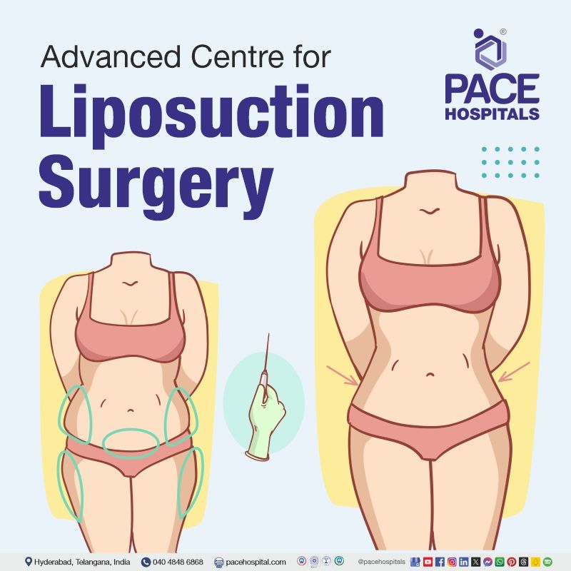 Advanced Centre for Liposuction surgery in Hyderabad, India liposuction surgery cost in Hyderabad | best liposuction surgery in Hyderabad | best liposuction treatment in Hyderabad | laser liposuction Hyderabad cost | Liposuction Procedure near me