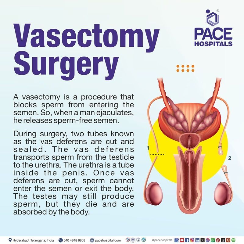 Vasectomy meaning​ | vasectomy Definition | vasectomy procedure