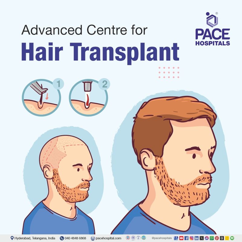 Advanced Centre for Hair Transplant Surgery in Hyderabad, India hair transplant meaning | best hair transplant in Hyderabad | hair transplant surgery in India | hair transplant cost in India | fue and fut hair transplant surgery in Hyderabad India