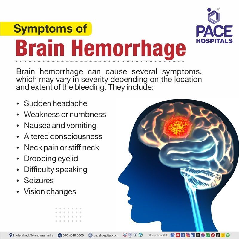 Symptoms of brain hemorrhage brain hemorrhage symptoms | symptoms of brain hemorrhage | slow brain hemorrhage symptoms | what are the symptoms of brain hemorrhage