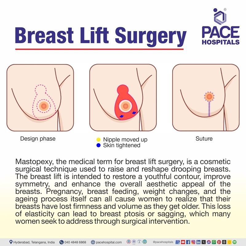 Breast lift surgery - mastopexy meaning breast lift surgery | breast lift surgery near me | mastopexy | what is breast lift surgery | breast lift mastopexy surgery