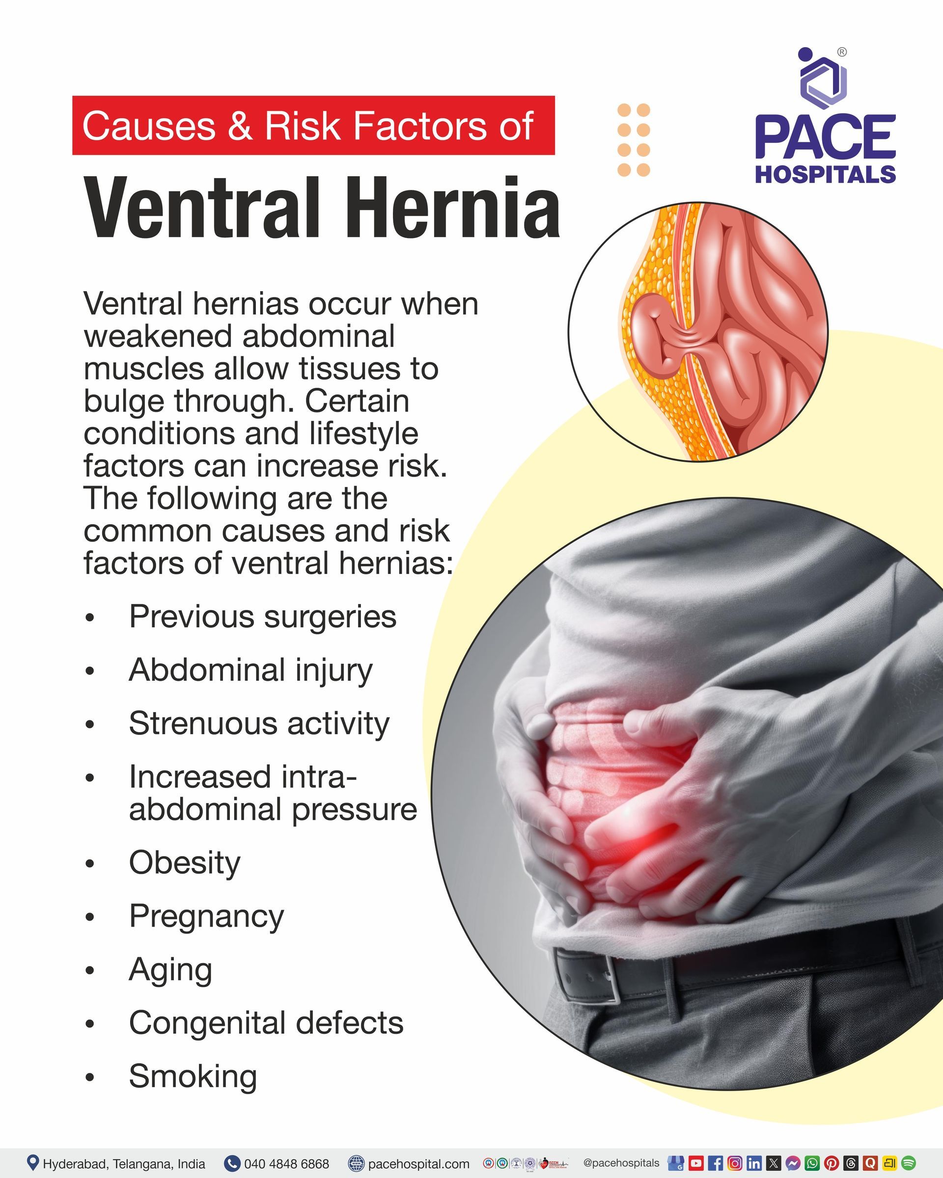 Causes of Femoral Hernia Causes of Femoral Hernia I Femoral Hernia Causes I What causes a femoral hernia