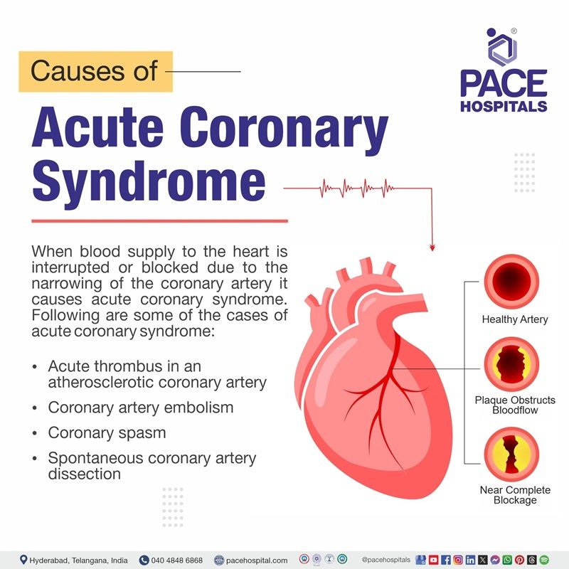 acute coronary syndrome causes​ | most common cause of acute coronary syndrome​ | Causes of acute coronary syndrome | What are the causes of acute coronary syndrome
