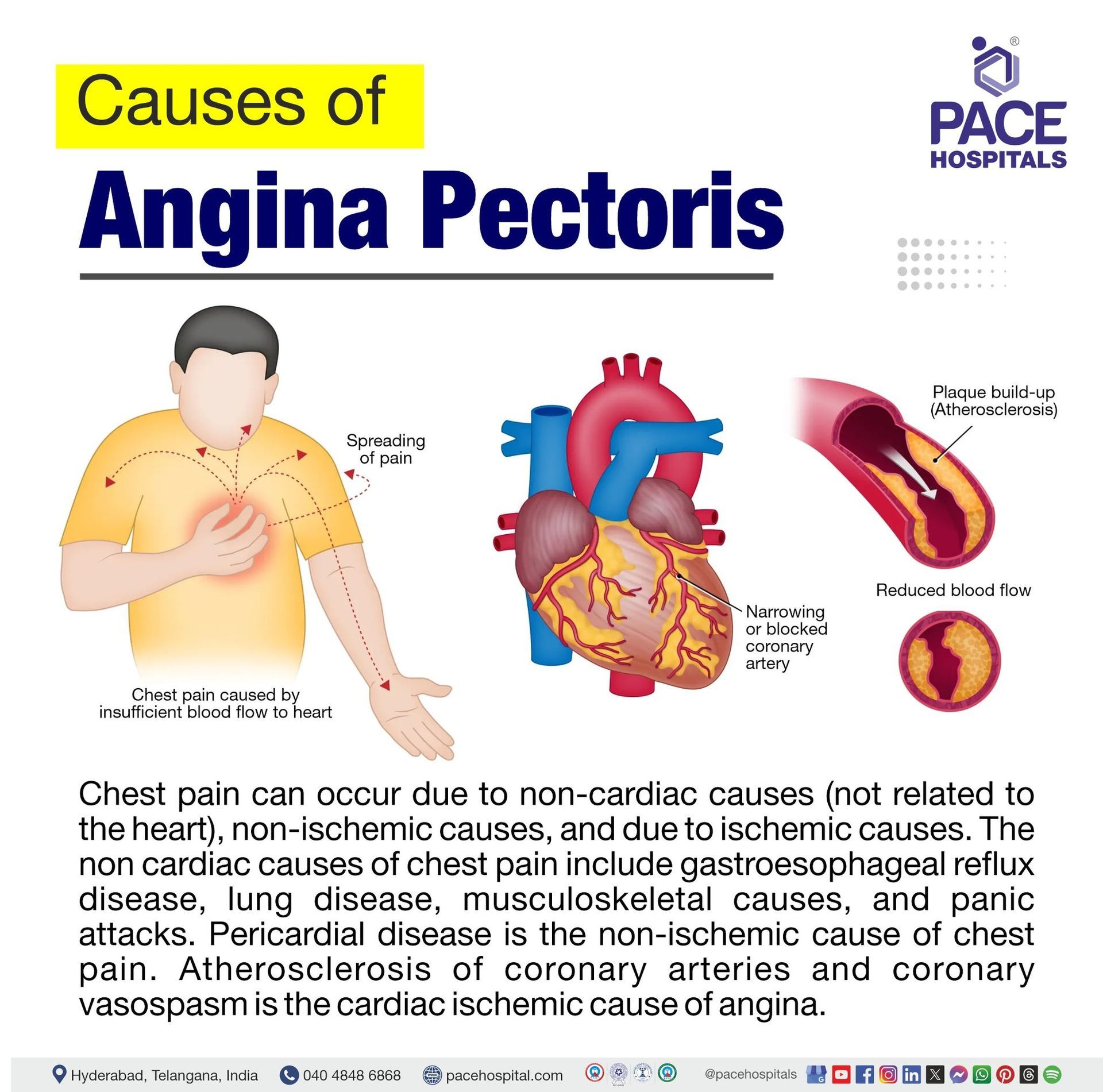 Angina pectoris causes angina pectoris causes | what is angina pectoris and what causes it
| angina pectoris is caused by | what causes angina pectoris