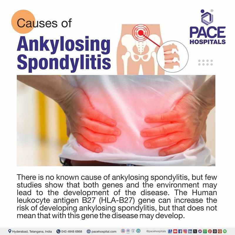 Ankylosing Spondylitis Causes Ankylosing Spondylitis Causes | Visual showing the causes of Ankylosing Spondylitis