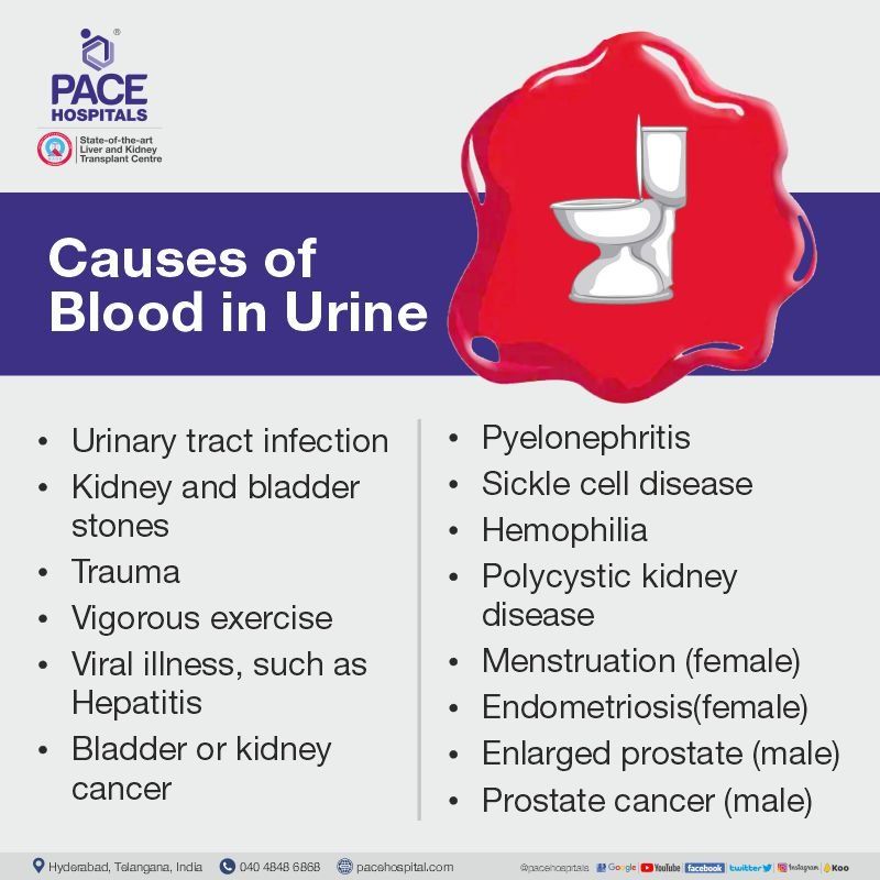 blood in urine or hematuria causes blood in urine or hematuria causes
