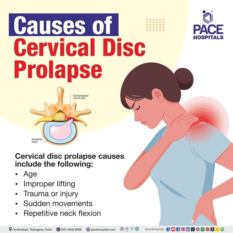 Causes of Cervical Disc Prolapse cervical disc prolapse causes | Causes of Cervical Disc Prolapse | what causes Cervical Disc Prolapse | Visual outlining the causes of Cervical Disc Prolapse | What are the causes of Cervical Disc Prolapse