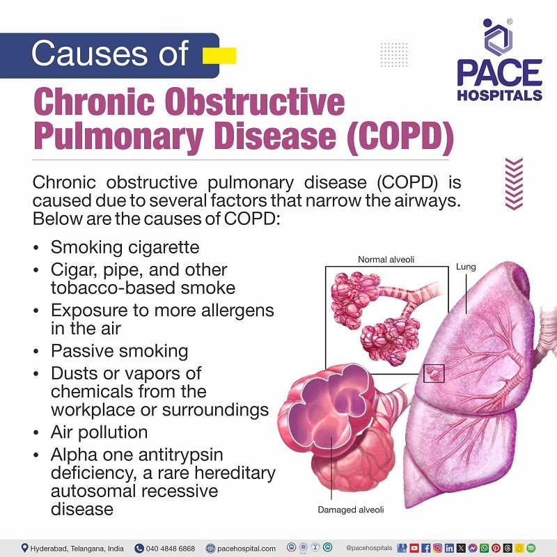 COPD causes COPD causes | causes of COPD disease | what causes COPD | COPD causes and risk factors | COPD is caused by | Visual depicting the causes of COPD