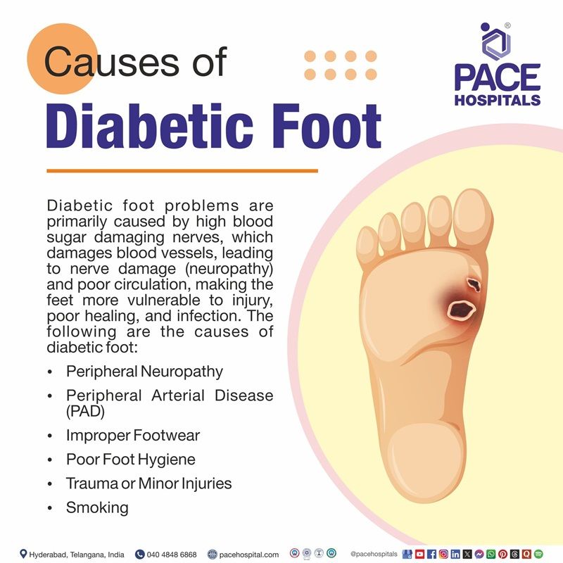 Diabetic Foot Causes Diabetic Foot Causes | Visual depicting Diabetic Foot Causes