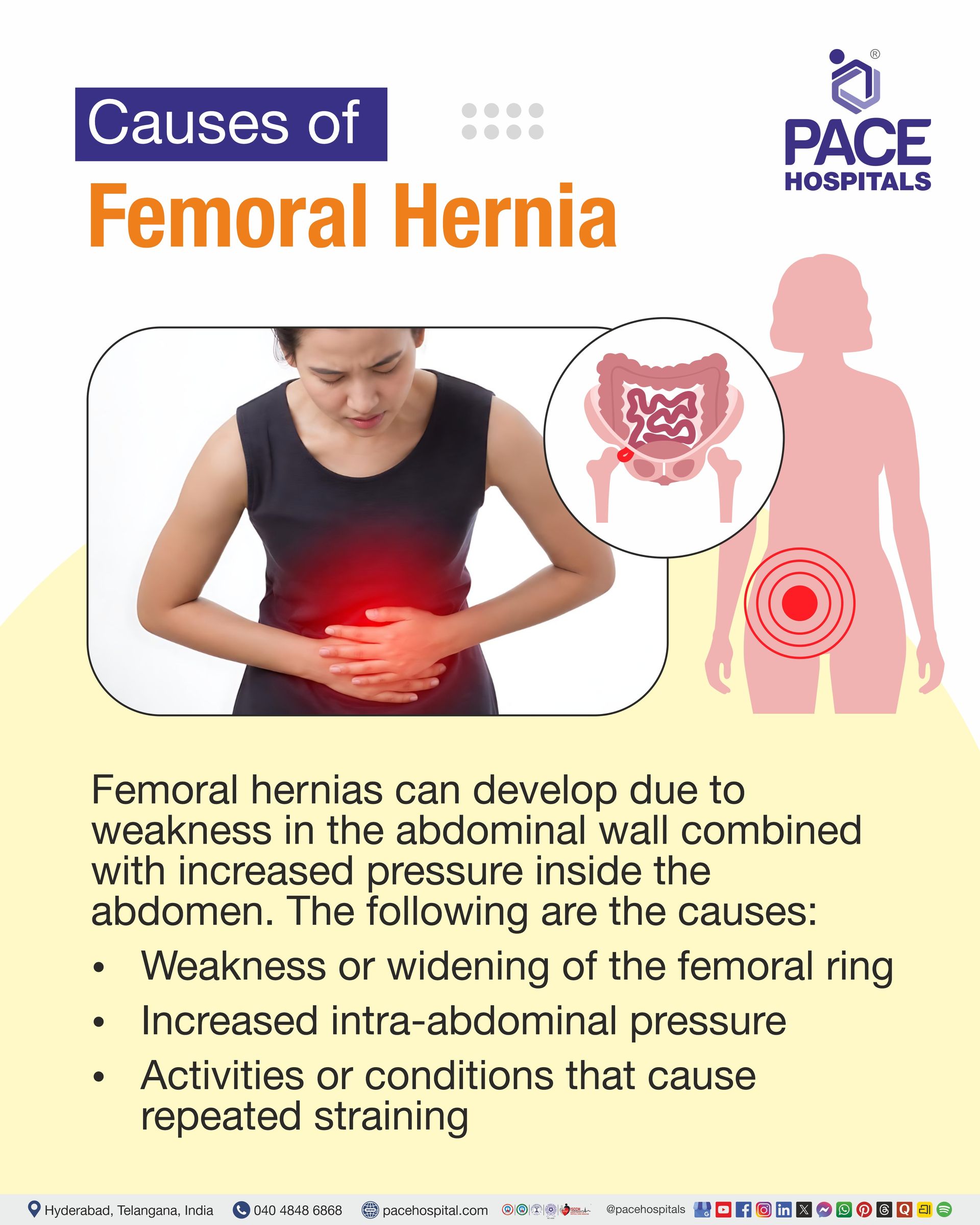 Causes of Femoral Hernia Causes of Femoral Hernia I Femoral Hernia Causes I What causes a femoral hernia