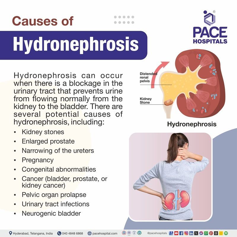Causes of hydronephrosis Hydronephrosis causes | hydronephrosis causes in adults | causes of hydronephrosis in infants | causes of hydronephrosis in kidney | causes of mild hydronephrosis