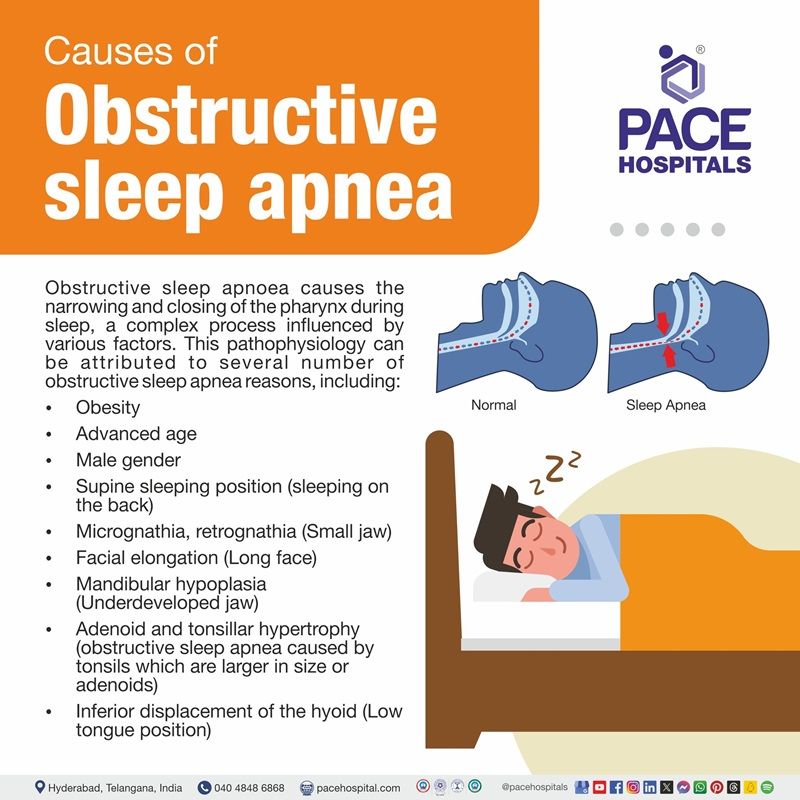 Causes obstructive sleep apnea obstructive sleep apnea causes | what causes obstructive sleep apnea | causes of obstructive sleep apnea | Visual depicting the Causes of obstructive sleep apnea (OSA)
