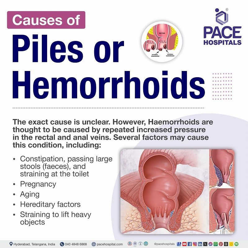 Piles Causes piles causes | hemorrhoids causes | what causes piles | causes of piles in male and Female | causes of external piles | how are piles caused | Visual outlining the causes of Piles (hemorrhoids)