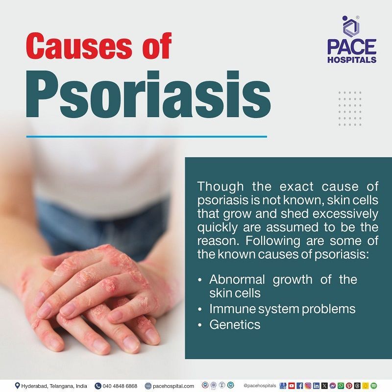 Psoriasis causes Psoriasis causes | what causes scalp psoriasis | psoriasis causes due to | psoriasis is caused by | cause of psoriasis disease | Visual explaining the causes of Psoriasis