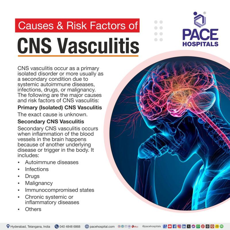 Central Nervous System (CNS) Vasculitis Causes and Risk Factors Central nervous system vasculitis causes | CNS Vasculitis Causes | CNS Vasculitis risk factors