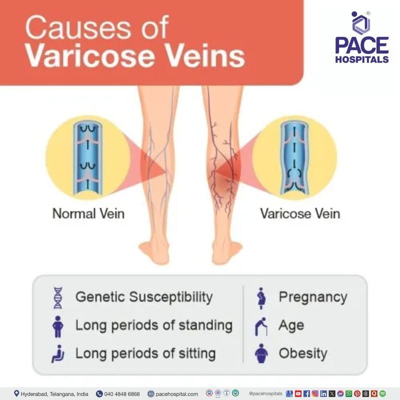 what causes varicose veins | Varicose Veins Causes