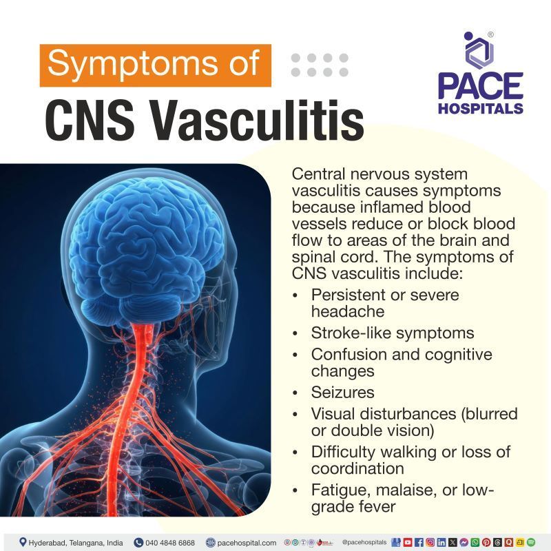 Central Nervous System (CNS) Vasculitis Symptoms Central nervous system vasculitis symptoms | CNS Vasculitis Symptoms