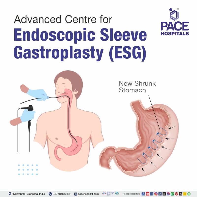 Advanced Centre for Endoscopic Sleeve Gastroplasty (ESG) in Hyderabad, India endoscopic sleeve gastroplasty near me | endoscopic sleeve gastroplasty cost in Hyderabad India | Best hospital for Endoscopic Sleeve Gastroplasty in Hyderabad India
