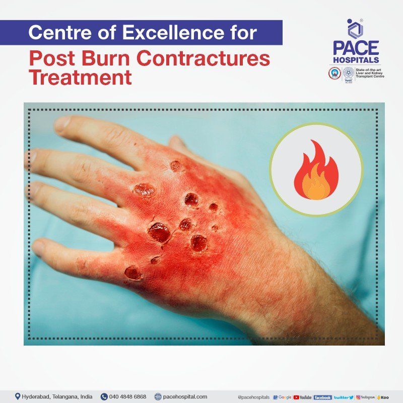 Post burn contracture surgery Post burn contracture surgery in Hyderabad | burns and post burn contractures