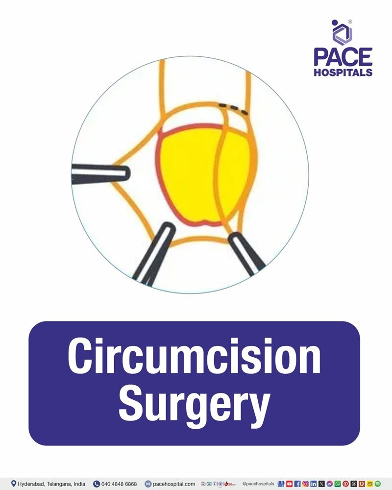 Cost of Circumcision Surgery in Hyderabad at PACE Hospitals, Circumcision Surgery Cost estimate